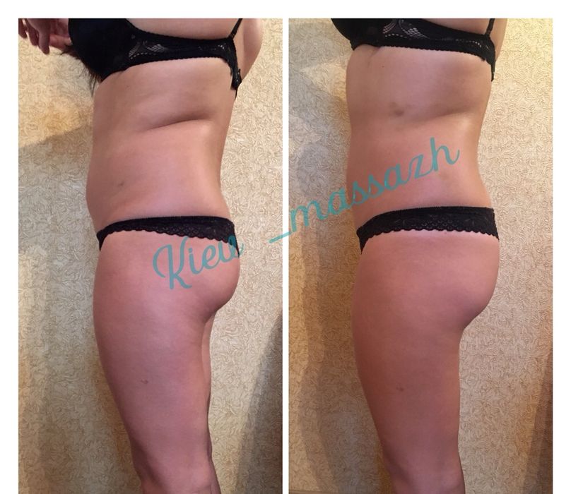 Антицеллюлитный массаж ЖК София