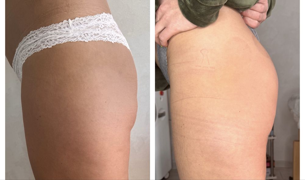 Массаж/ коррекция фигуры/ лазерная эпиляция/поселок Котовского