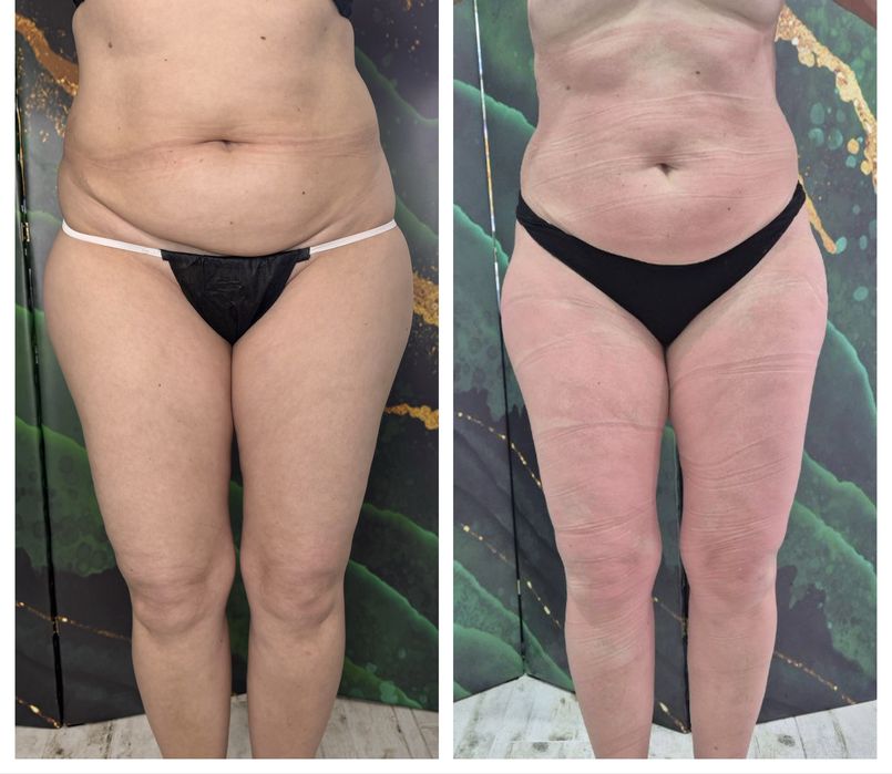 Массаж/ коррекция фигуры/ лазерная эпиляция/поселок Котовского