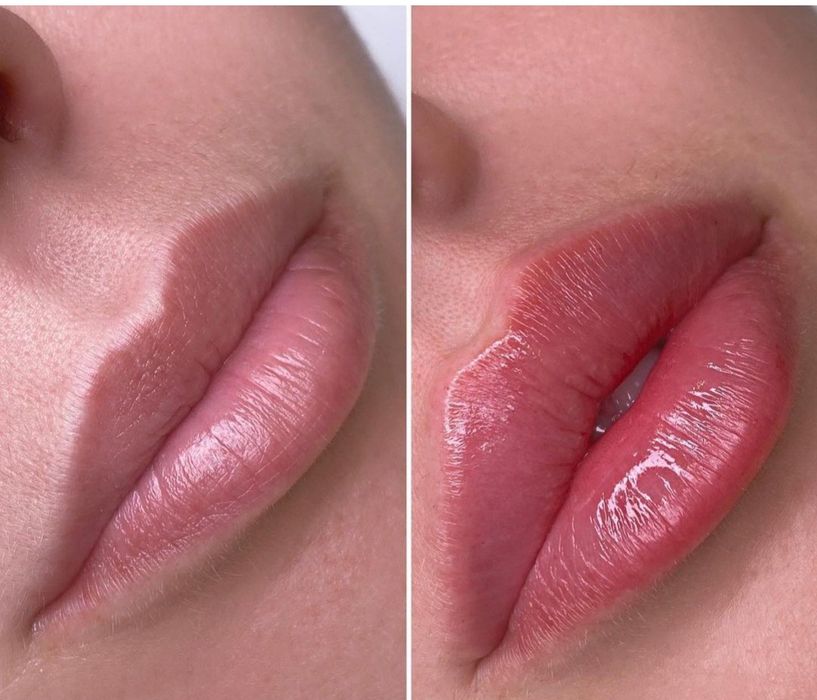 Ботокс, Контурная пластика Услуги косметолога.