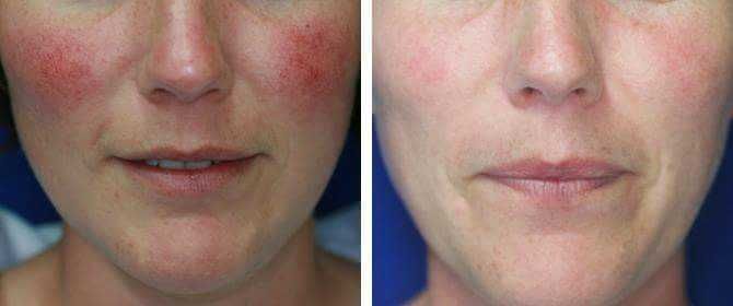 Laser, Platforma Wieloadaniowa  +    IPL/SHR    +   Nd-Yag    +   RF