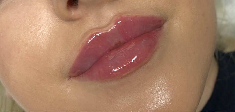 Zabiegi Wrocław / Stymulatory / BTX/ Usta