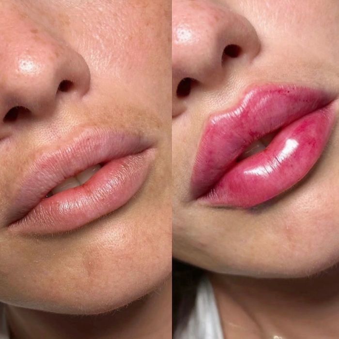 Увеличение губ.Контурная пластика.Ботокс.Биоревитализация.Липолитики.