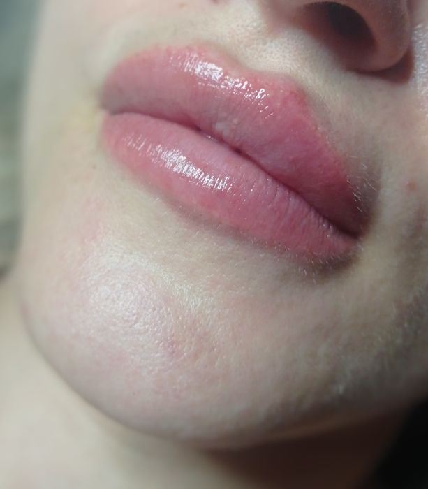 Ботокс, Контурная пластика Услуги косметолога.