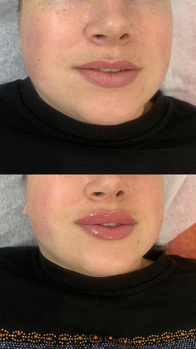 Увеличение губ ,индивидуальный подход. Сертифицированные препараты