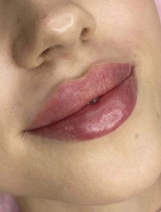 Powiększanie UST 300 zł /Btx/depilacja laserowa