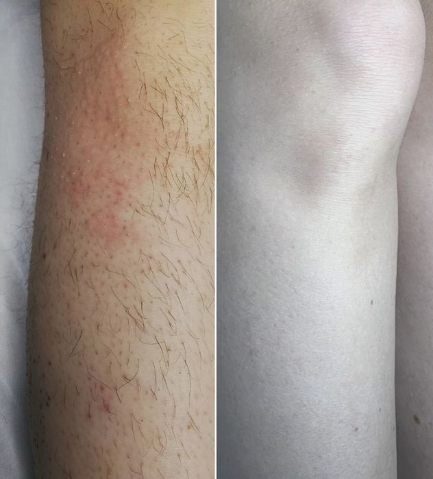 Электроэпиляция. Електроепіляція. Видалення волосся назавжди