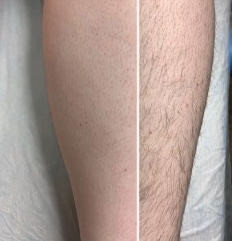 Депіляція віск Депиляция Воск Чернігів УЗ чистка обличчя