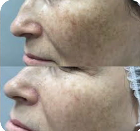 Плазмоліфтінг. Послуги косметолога.