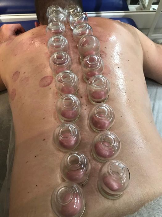 Stawianie baniek ogniowych lekarskich Dojazd do Pacjenta