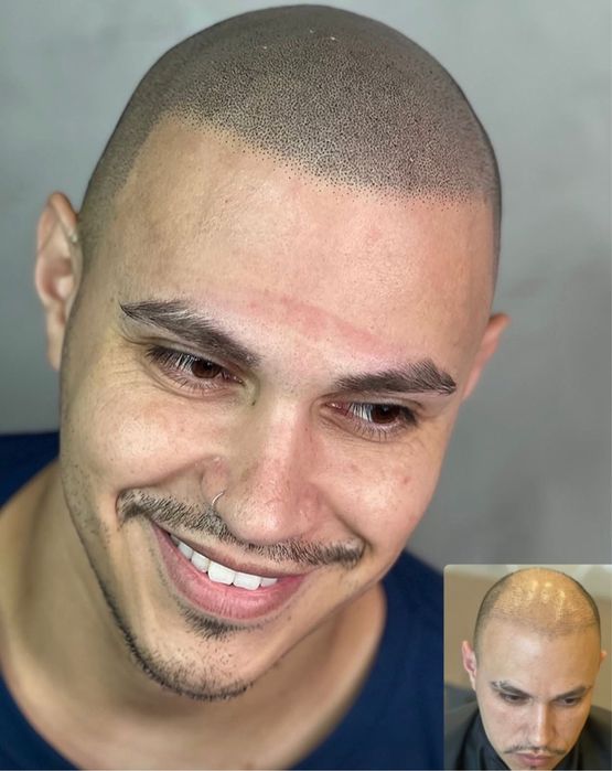 Micropigmentação Capilar Profissional – Porto