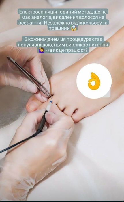 Електроепіляція видалення волосся