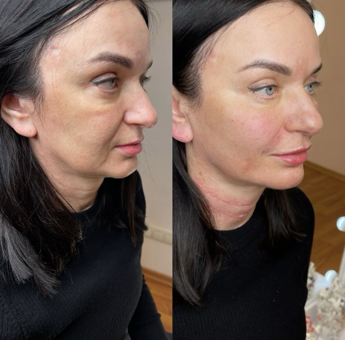 Увеличение губ. Контурная пластика. Губы. Ботокс.Нити.Фулфейс