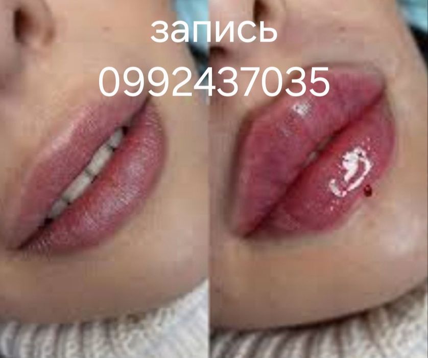 АКЦИЯ!!! Увеличение губ 1700 грн. Колличество мест ограничено!