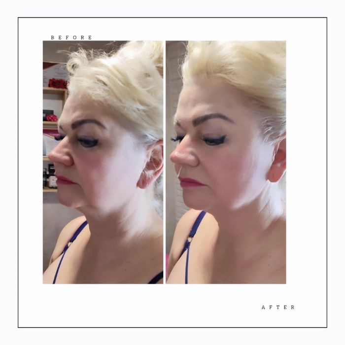 smas lifting без операційна підтяжка обличчя