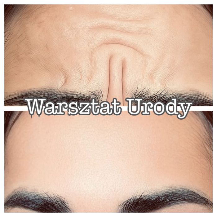 -50% POWIĘKSZANIE UST botox btx kwas hialuronowy NICI HACZYKOWE