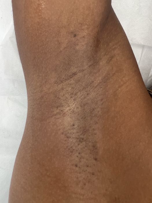 Depilação a laser