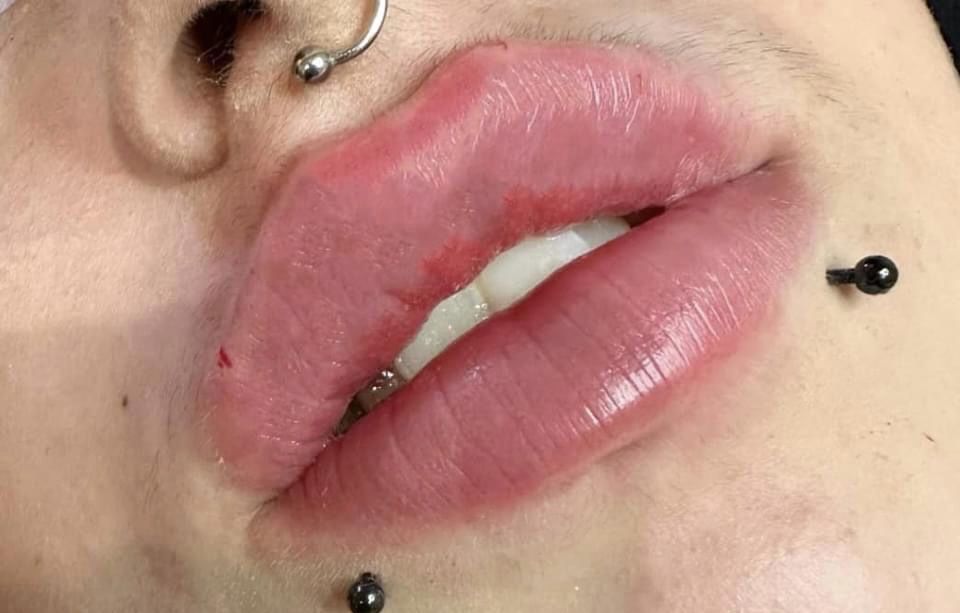 Usta na płasko, BTX, mezoterapia, lipoliza