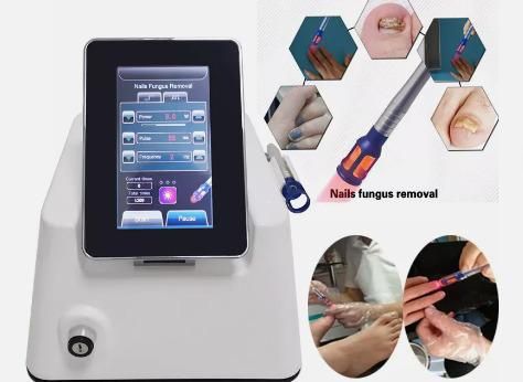 Laser de remoção de fungos das unhas