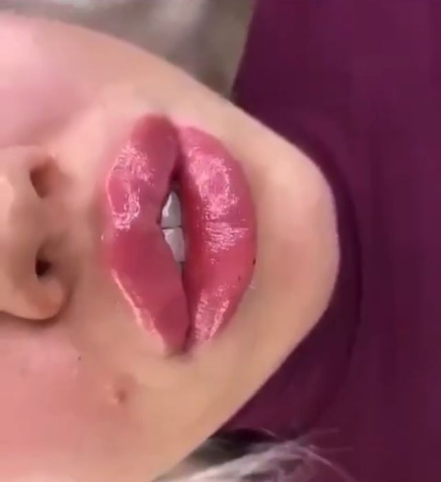 Акция!Индивидуальное обучение:ботулинотерапия,контурная пластика губ