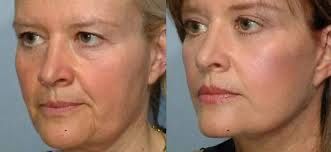 Масаж Ендосфера для жінок