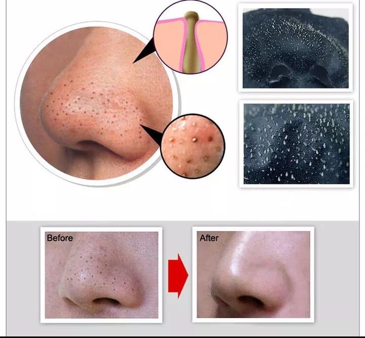 Máscara  para eliminar  os pontos negros