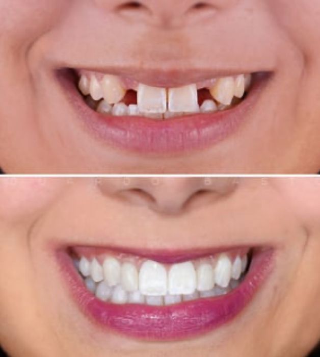 Sorriso brilhante e confiante sem dor de ouvido