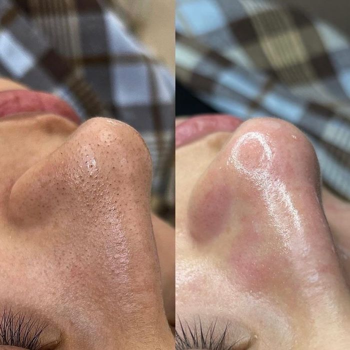Limpeza De Pele