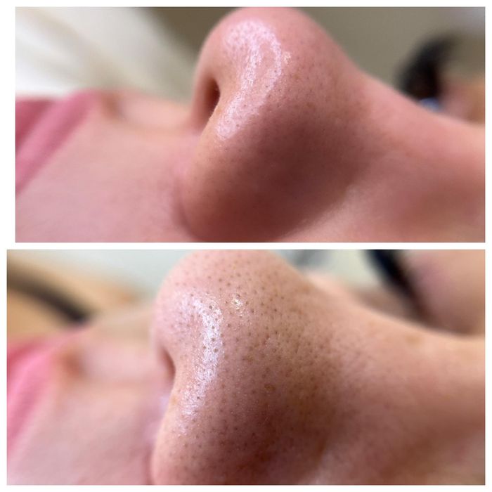 Limpeza de pele profunda