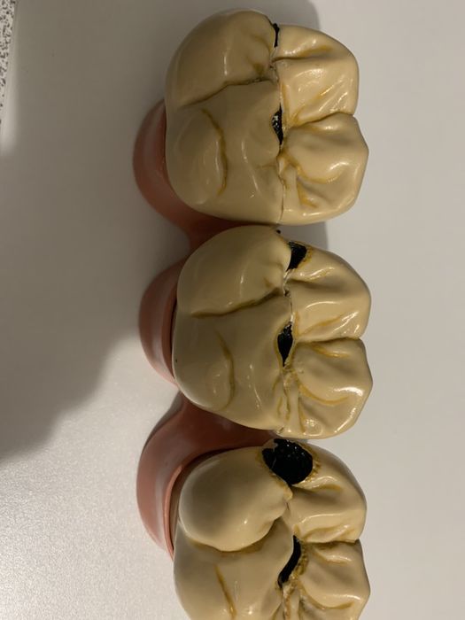 Modelo didático evolucão caries