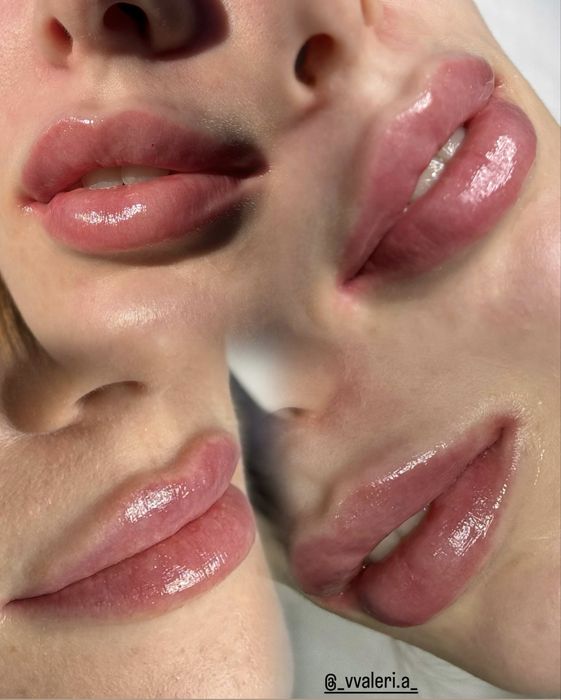 Збільшення губ/ Увеличение губ КП