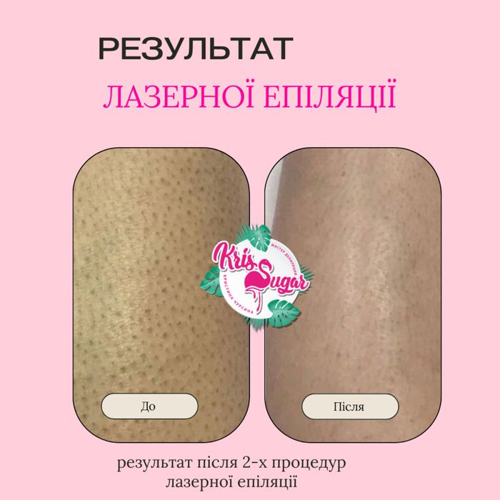Лазерная эпиляция