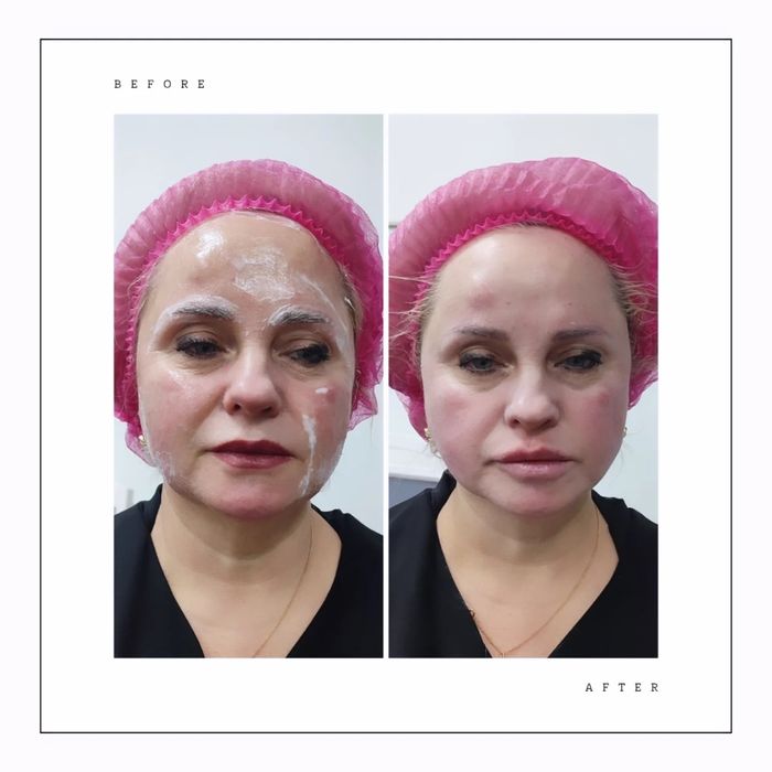 smas lifting без операційна підтяжка обличчя