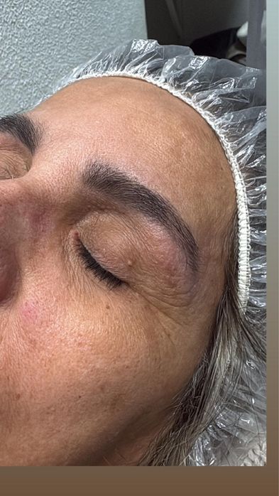 Epilação à linha ao domicilio