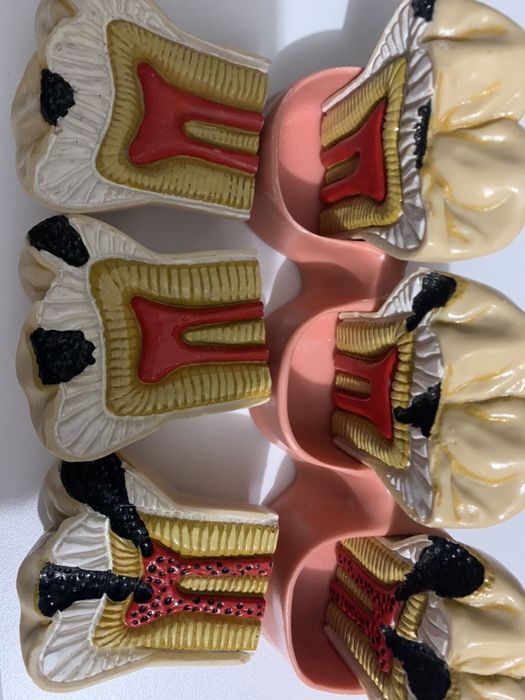 Modelo didático evolucão caries