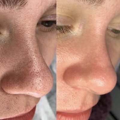 Косметолог, эпиляция