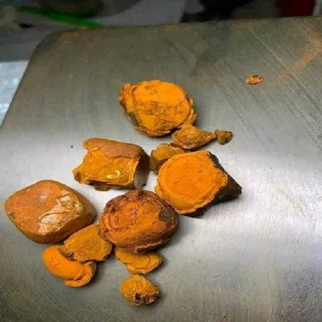 Cálculos biliares naturais para exposição ou estudo