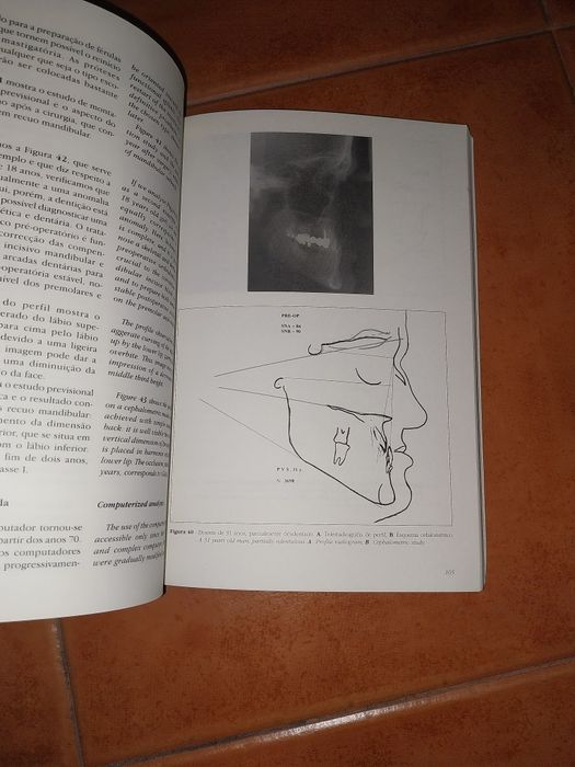 Anomalias de Classe III Prognatismo - Medicina  Dentária
