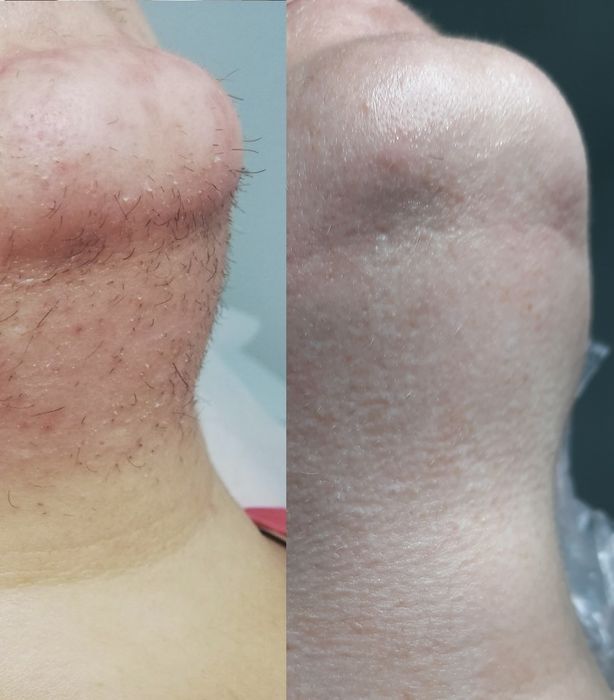 Электроэпиляция. Електроепіляція. Видалення волосся назавжди