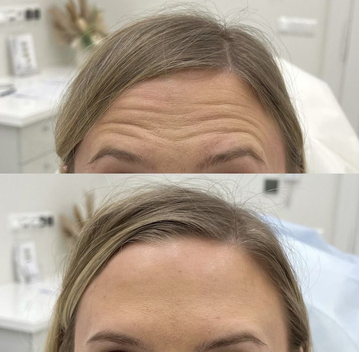 Botoks w domu klienta badz stacjonarnie w salonie