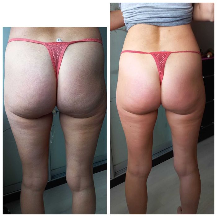 Лікувально оздоровчий масаж,антицелюлітний масаж Дарницький рн Позняки