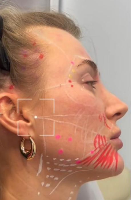 Акция!Индивидуальное обучение:ботулинотерапия,контурная пластика губ