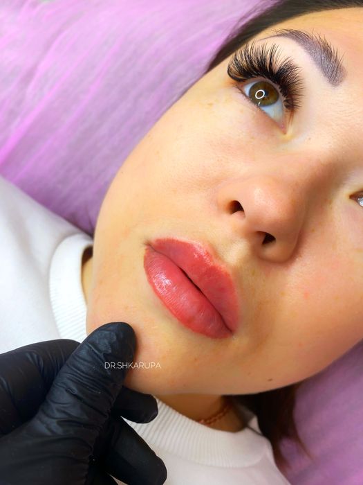 Акція! Stylage M / Контурна пластика губ /увеличение губ