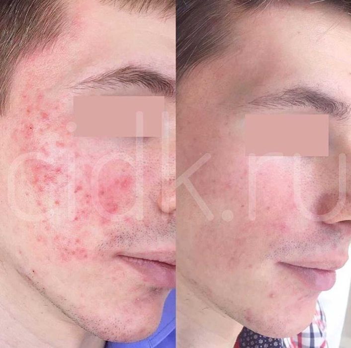 Osocze i Fibryna Kroplówki Detoks Cewnikowanie