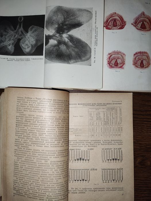 книги 30х, 40х: Туберкулёз бронхиальных желез гортани Гальванокаустика