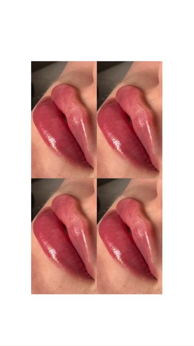 Ботокс чоло-1900 грн!Біоревіталізація, збільшення губ Одеса, центр