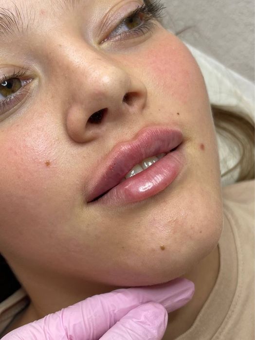 Косметолог, увеличить губы, пілінг, контурна пластика