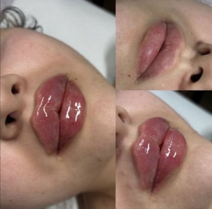 Botox, Powiększanie ust