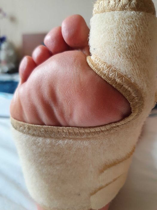 Бандаж(левый) при вальгусной деформации,травмах первого пальца.