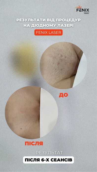 Лазерна епіляція Дніпро(лівий берег)